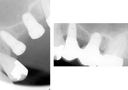 術後デンタルレントゲン写真