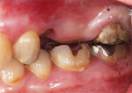 術前抜歯直後口腔内写真