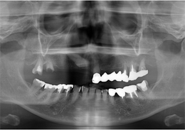 術前パノラマレントゲン写真