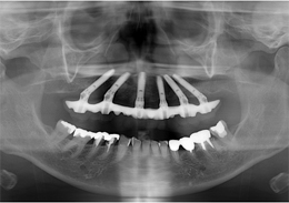 術後パノラマレントゲン写真