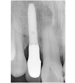 術後パノラマレントゲン写真